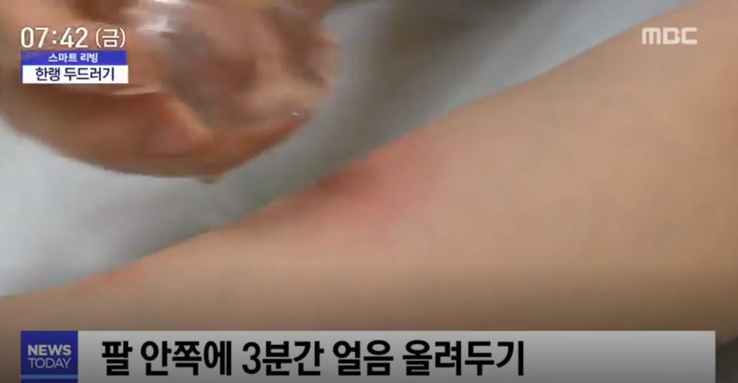 '한랭 두드러기' 증상이 심하면 쇼크사 불러올 수 있어…원인과 치료법 및 예방법 알아보자