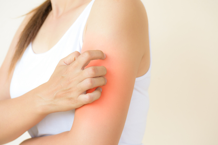 자작곡 발표로 쉴 틈 없는 '방탄(BTS)' 뷔, '콜린성두드러기' 증상 잘 쉬고 흉터 남지 않게 꾸준한 치료해야