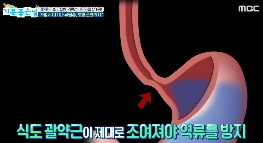 역류성식도염 완화하는 베개 높이? 기침·가슴통증 유발해 위내시경 필요