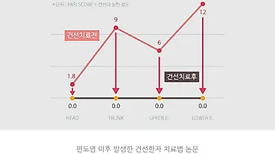 건선은 피부 감기? 편도염 이후 잘 나타나