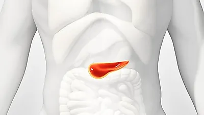 췌장암 초기 증상 알아채기 어려워, 췌장암 원인은?
