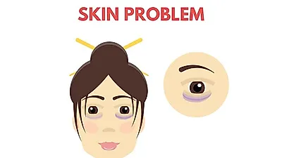 피곤해보이는 '눈밑 색소침착' 다크써클없애는 법은?