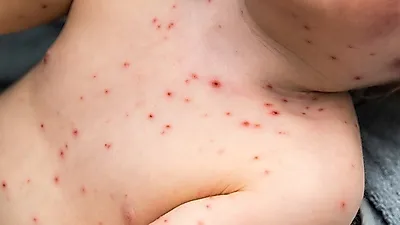수두 초기증상, 발진과 수포 온 몸에 생겨...대부분 자연치유돼