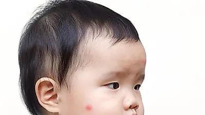[날파리·모기 퇴치법] 날파리 생기는 이유와 날파리 없애는 법, 아기 모기 물렸을 때 대처방법