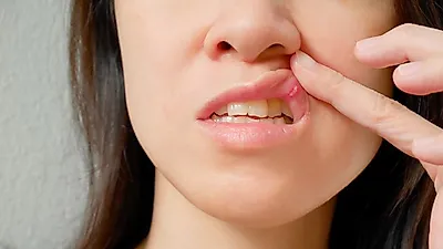 [입 안에 찾아온 불청객] 입 안이 허는 이유 '구내염'의 원인과 증상, 빨리 낫는 법, 구내염에 좋은 음식