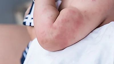 막양낙설, 발진 등 '가와사키병' 원인이 되는 요인은?