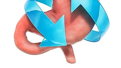 '역류성식도염', 증상과 치료법 몰랐다면 초기에 알고 '이렇게' 해결할 수 있다