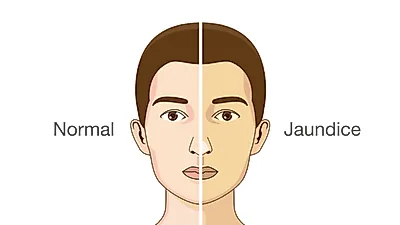 눈에 황달, 유상철 '췌장암' 루머 병명 아직... 황달 증상 췌장암·간암말고 가벼운 원인질환도 있어