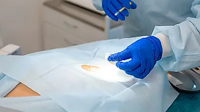 쥐젖 제거, 실로 묶는 민간요법 염증 유발 가능성 있어... 수술 후 관리법