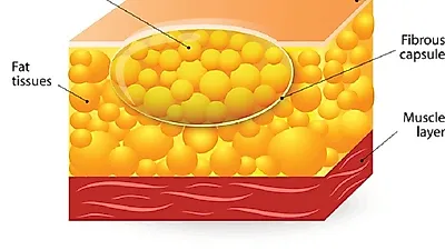 피부 밑 혹 통증, 지방종 제거 수술 필요