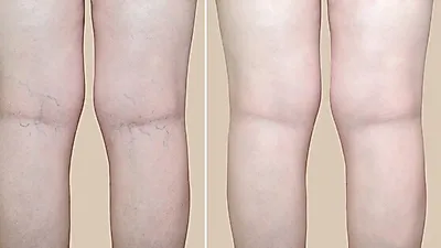 하지정맥류 수술방법, 절개 말고 레이저로 가능? 타는 듯한 통증 '하지정맥류' 증상 다리에 쥐가 나는 이유?