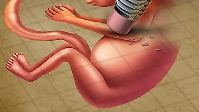이영호·류지혜 낙태, '낙태죄' 남자는 처벌 제외? 임신중절(낙태)수술부터 임신 초기낙태까지 총정리