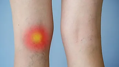 현대인들의 고질병? 하지정맥류 증상 가벼운 운동으로 증상 완화 가능하지만 수술한 필요한 경우도 있어…