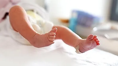 우리 아이 위협하는 희귀병, '에이퍼트 증후군'…증상 및 치료는?