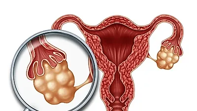 종잡을 수 없는 생리주기, 다낭성난소증후군 증상이 원인?