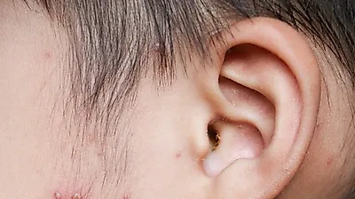 합병증 불러올 수 있어 더 위험한 '수족구병 증상', 치료제 없어 예방에 각별히 주의해야…