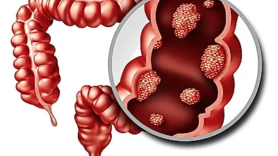 대장암 원인 서구화된 식습관과 비만, 대장암 초기증상 놓치지 않는 것이 중요해