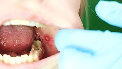 전염되는 '수족구' 증상, 유아 구내염·감기 증상과 달라... 아기 수족구 증상과 성인 수족구병 치료