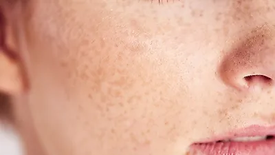 피부미인의 적 기미의 원인 및 기미 없애는 법은?