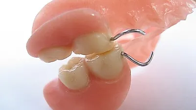 [잇몸건강]   "장·단점 알고 치료받으세요"   임플란트 및 틀니…선택 시 알아야 할 사항은?
