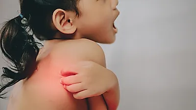 여름철, '아기 모기 물렸을 때' 붓기 및 물집 관리법은?