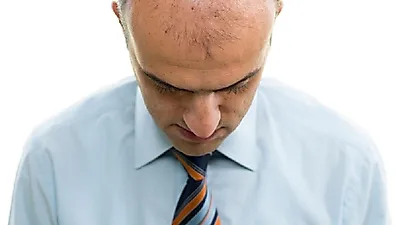 갑자기 빠지는 머리...원형탈모 치료법과 원인