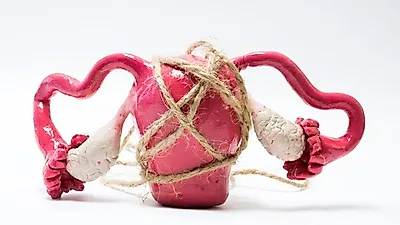 생리불순·자궁내막암 등 다양한 증상을 유발하는 다낭성 난소 증후군 치료 방법, 적절한 검사 선행돼야
