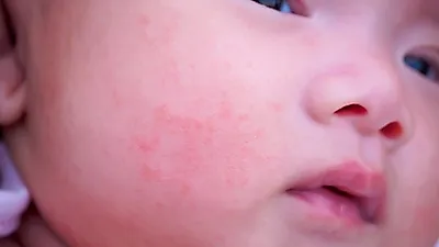 세심한 주의가 필요한 '아기아토피 증상'과 '아토피피해야할음식'