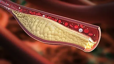 [혈관 다이어트] 혈관 찌꺼기 쏙 빼는 크릴오일·미역약소금, 어떤 효능 있길래 혈관에 좋은 음식? 추천·효능·부작용·복용법 소개