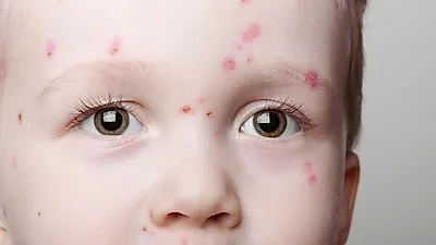 수족구병 초기증상 유행, 성인·아기 수족구병 증상과 치료법은?…수족구병 잠복기와 전염도 알아보자
