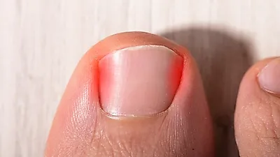내성발톱 악화되기 전에 치료하면 내성발톱 교정, 내성발톱 자가치료로도 충분하다?