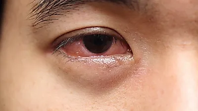 [유행성 결막염]결막염 증상·치료 방법은?