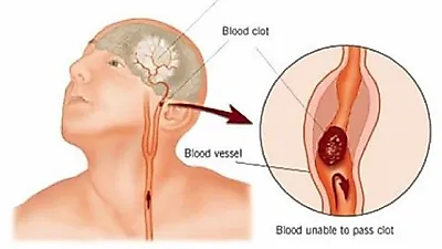 갑자기 한쪽 팔이나 다리에 힘이 없어지는 뇌졸중 전조증상...유심히 살펴서 진료 받아야