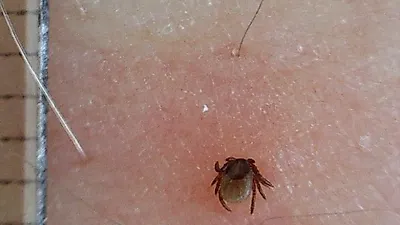 두 살 배기 아기, 진드기에 물려 숨져