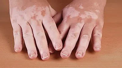 몸에 흰 반점이 생기는 백반증