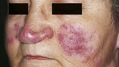희귀 난치병, '루푸스 병' 원인과 유형