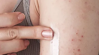 지루성피부염, 신생아와 중년 남성들이 주로 걸려…' 지루성피부염치료 부터 안면홍조치료 까지'