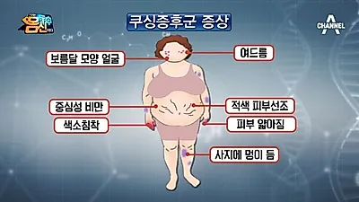 비만 체형으로 변하는 쿠싱증후군, 여성의 남성화 원인 쿠싱증후군 증상일 수 있어, 쿠싱증후군이란?