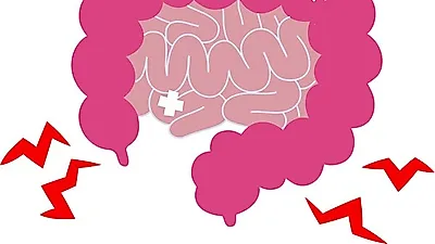 사소한 증상이 대장암 초기증상일 수 있어…생존율 낮은 대장암 예방법 및 대장암에 좋은 음식