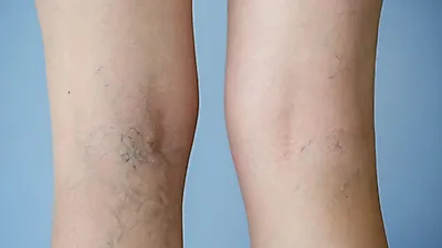 핏줄이 보이는 '하지정맥류' 통증과 좋은 음식은?