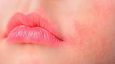 접촉성피부염, 원인부터 주요증상, 치료방법 까지