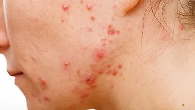 찌르는 듯한 고통 주는  '대상포진'... 초기증상 인지해 미리 예방접종 해야