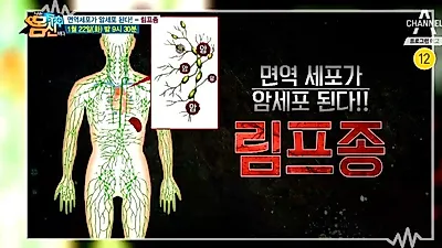 '림프종' 극복한 몸신 강림! 림프 강화 음식은?..림프종, '면역세포→암' 전신에 걸쳐 번지고 잠식해