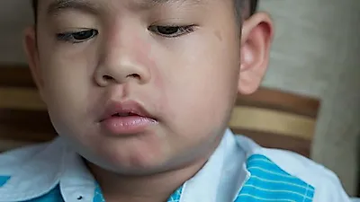겨울 환절기에 전염되는 볼거리 증상 및 합병증