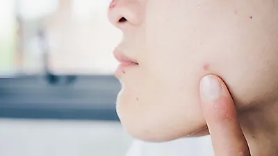화장하기 싫게 만드는 화농성 여드름과 '좁쌀 여드름 없애는 법'