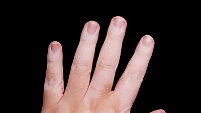 피부에 얼룩이 생기는 '백반증증상' 발생하는 원인은?
