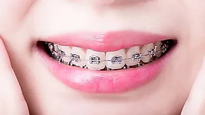 어서와 교정은 처음이지? 성공적인 치아교정을 위한 비용·기간·부작용 알아보기
