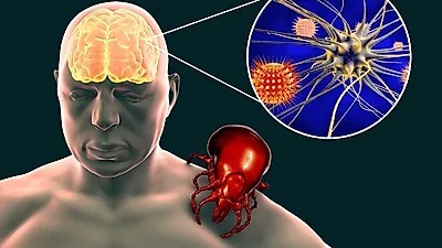 두통, 구토가 동반되는 뇌염...유아의 경우 끊임없이 울어