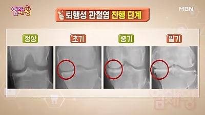 무릎에서 뚝뚝 소리? 무릎통증원인, 무릎관절에 좋은 운동+음식으로 치료하기