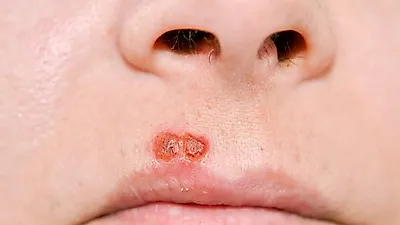 입술 물집…즉시 '헤르페스 치료' 필요